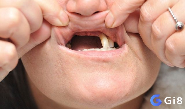Mơ gãy hết răng là biểu hiện của sự mất kiểm soát và sợ hãi trước thay đổi lớn